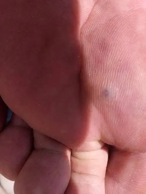 最近脚底长了这么个东西,是痣吗?还是只是磨得?