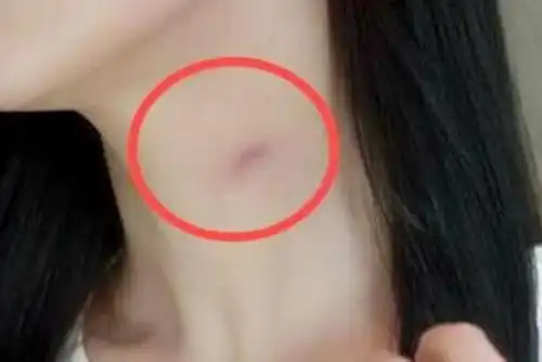 13岁女孩脖子上出现草莓印父母追问原因女孩的话引深思