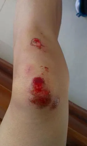 膝盖擦伤可以用硼酸洗液冲洗吗?再后用碘伏.