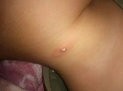 儿子脖子上长了个小肉瘤,是什么?怎么办?