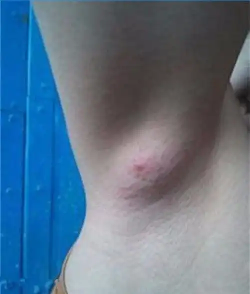 皮脂腺囊状上皮被逐渐增多的内容物膨胀所形成的潴留性囊肿