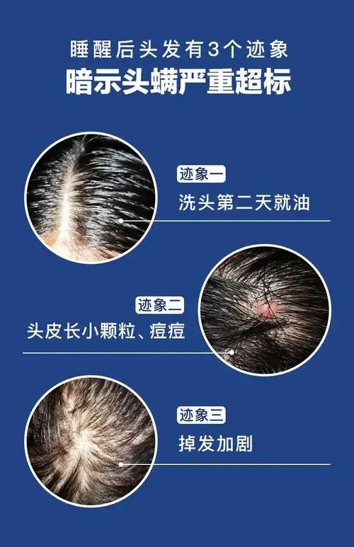 99%是螨虫祸害,用它!_头皮