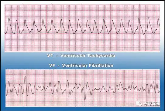 但如果是心搏停止(asystole) 或无脉性心电气活动 (pea arrest, 指的