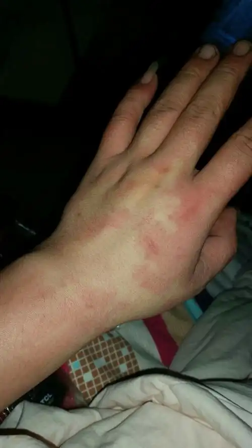 我这是不是酒精过敏啊,以前没有过,今天喝完后,发现身上全是这样的