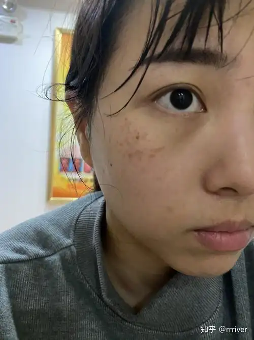 有谁褐青色痣治好过