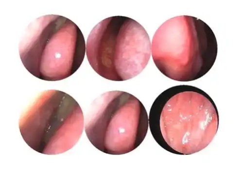 弘医堂:鼻息肉的种类有哪些?又有哪些典型症状?-郑州弘医堂