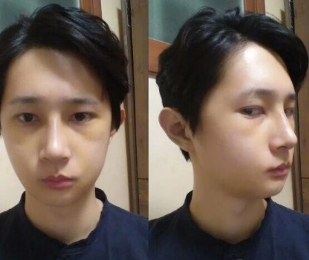 男性过大下颌角整形案例术后果堪称完美