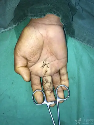 分享一例近指间关节屈曲挛缩松解