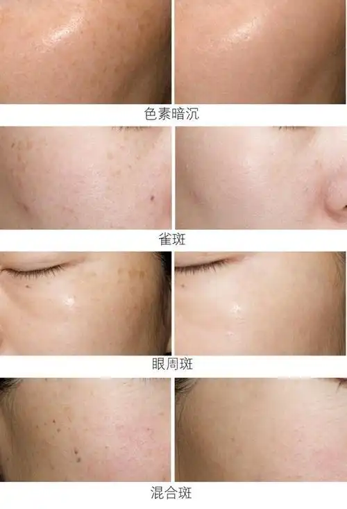 皮肤长斑怎么办 唯诺雅分享简单方法还你嫩白无瑕肌|色斑|美白|祛斑