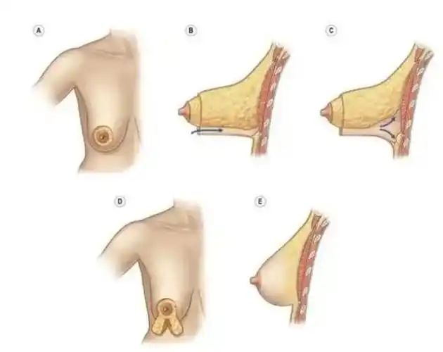 产后胸部松弛下垂,做双环悬吊提升会留疤?