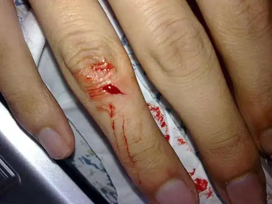 手指流血图片52
