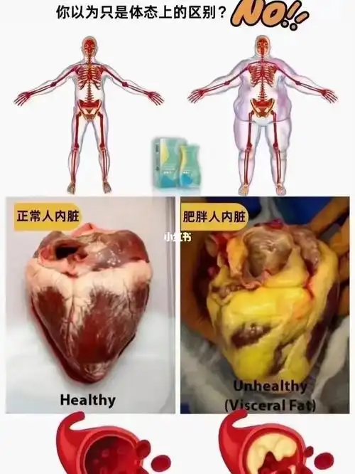 肚子大你以为只是不好看?_减肥_内脏脂肪_减肥_减肥其他