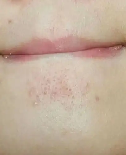 下巴上长白色小颗粒怎么办是闭口吗该怎么去除