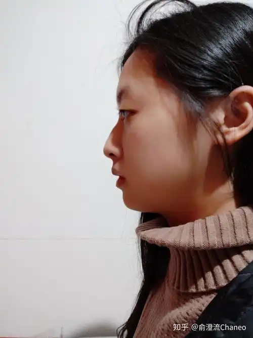 侧面看眼睛非常突,眉骨低和鼻子连接不起来是怎么回事?