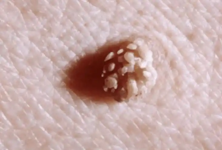 其实感染了hpv病毒之后,皮肤上会出现最典型的一个表现那就是会长出"