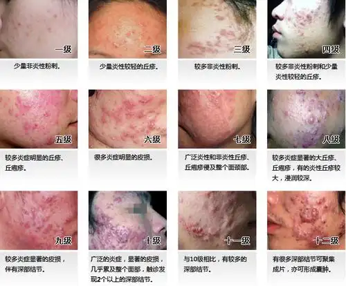 痤疮痘痘粉刺怎么治疗呢?