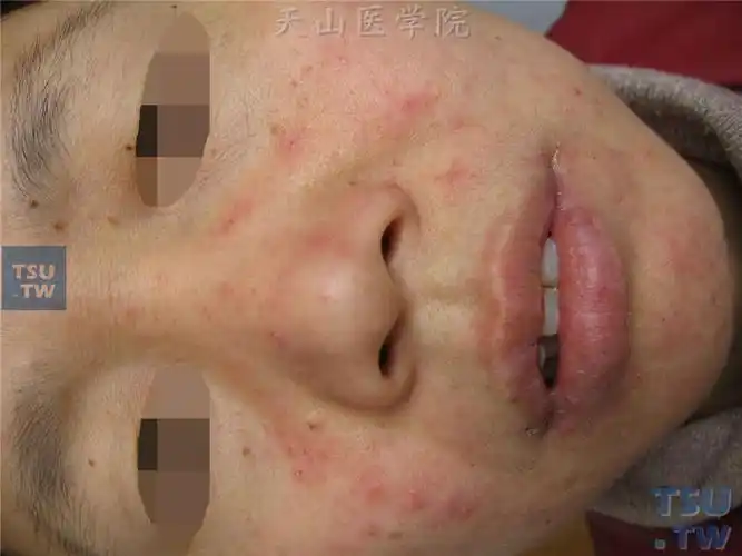 【图】毛囊虫病(demodiciosis)蠕形螨病的症状表现 - 皮肤病诊断图谱