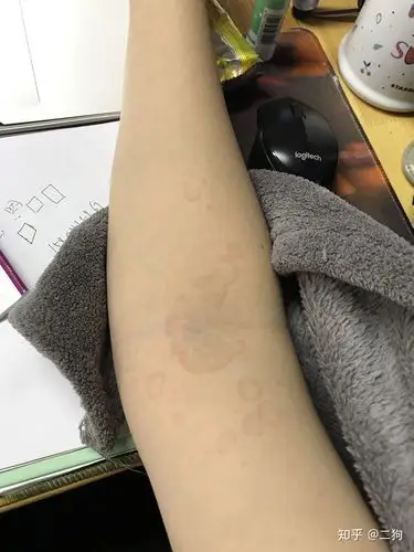 离心性环状红斑