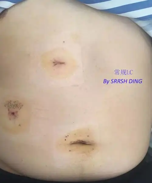 微切口腹腔镜胆囊切除术 - 好大夫在线