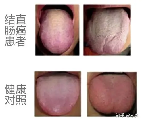 结直肠癌患者与健康对照的舌苔   来源:10.1016/j.micpath.2014.