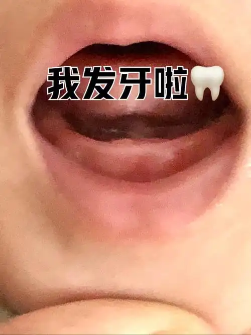 5m16days宝宝长牙啦