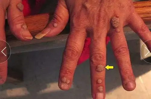 医生必须了解的 9 种病毒性疾病的皮肤黏膜表现-健康频道-手机搜狐