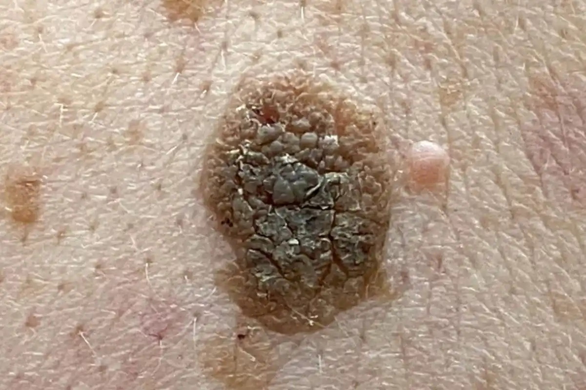 扁平疣,扁平苔癣和老年疣,有何关系?