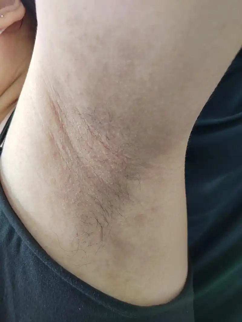 腋下瘙痒症状.#解决皮肤问题专注皮肤美容