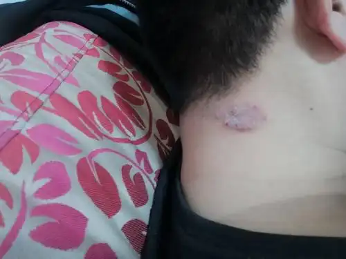 脖子起癣,,,,,,,,,,,,,,,,,,,,11,,,,,