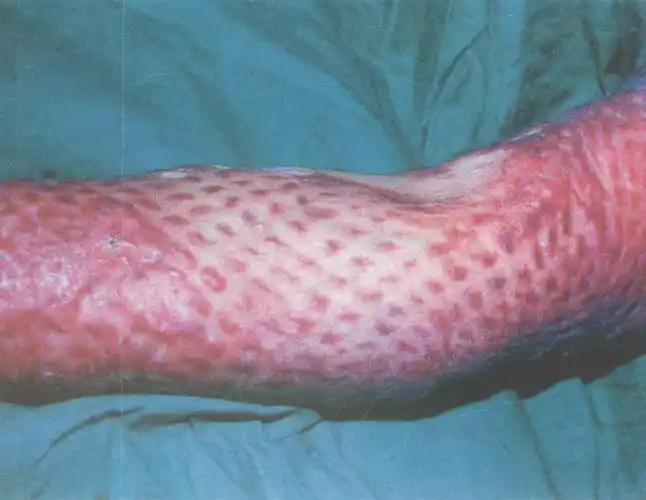 (图) 网状植皮瘢痕