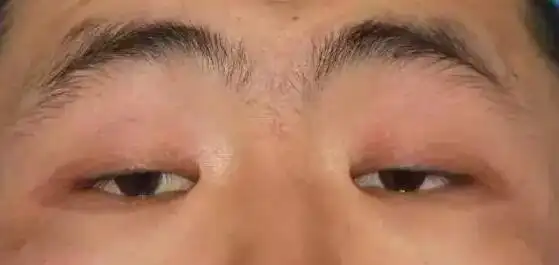 上睑下垂