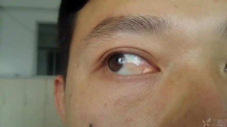 【眼表疾病讨论】泪阜部位的黄色肿物,看起来像脂肪瘤, 挤出黄色牙膏