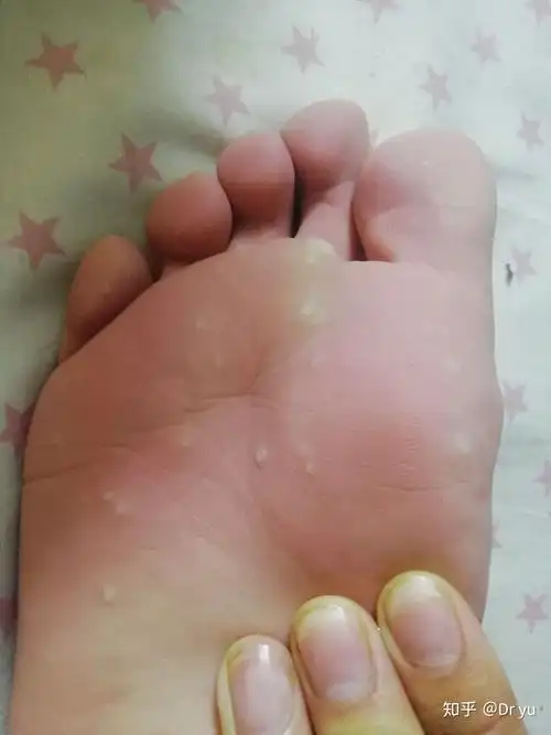 跖疣治疗的反思