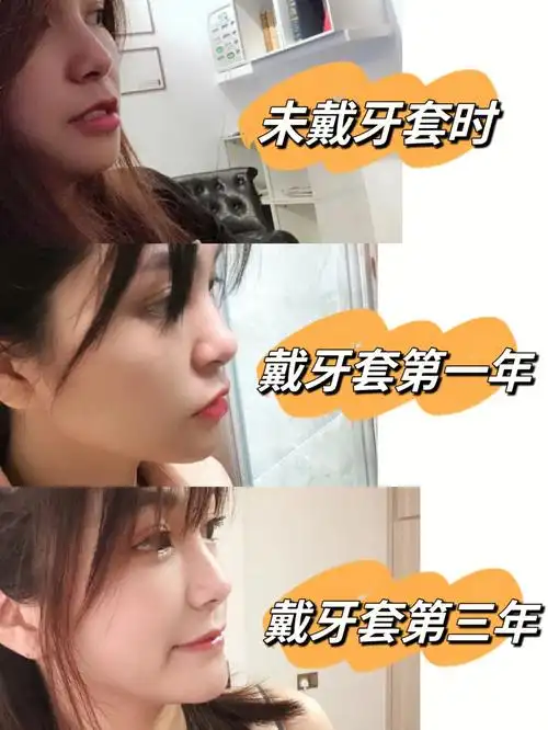 大龄骨性地包天|牙套毕业了