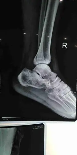 请问右跟骨粉碎性骨折怎么治疗