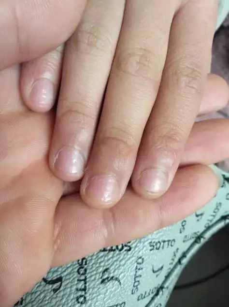 四岁小孩手指甲没有月牙白怎么回事