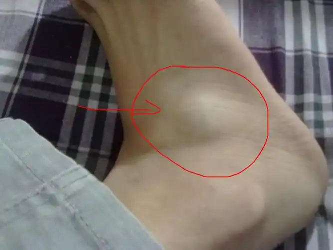 脚上有个大包是肿瘤吗(有图)