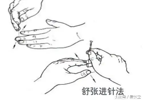 中医针灸之针刺手法