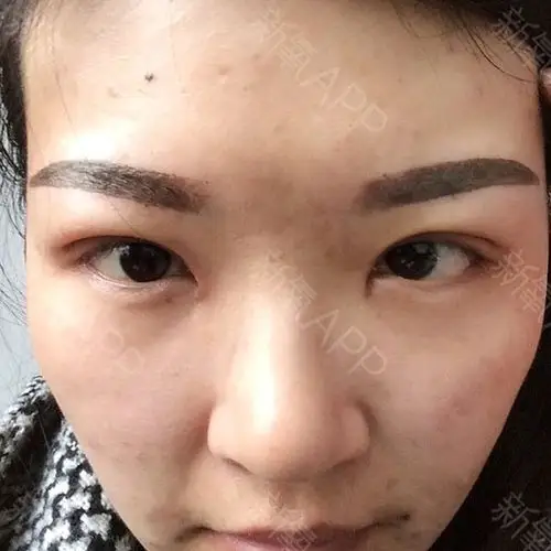 这是刚纹好第一天的眉毛,刚纹好的眉毛很粗,颜色很深_圈子-新氧美容