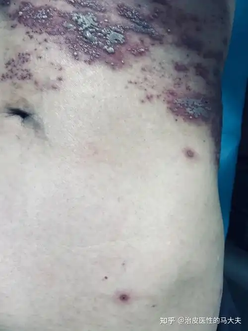 最近病毒性带状疱疹多吗? - 知乎