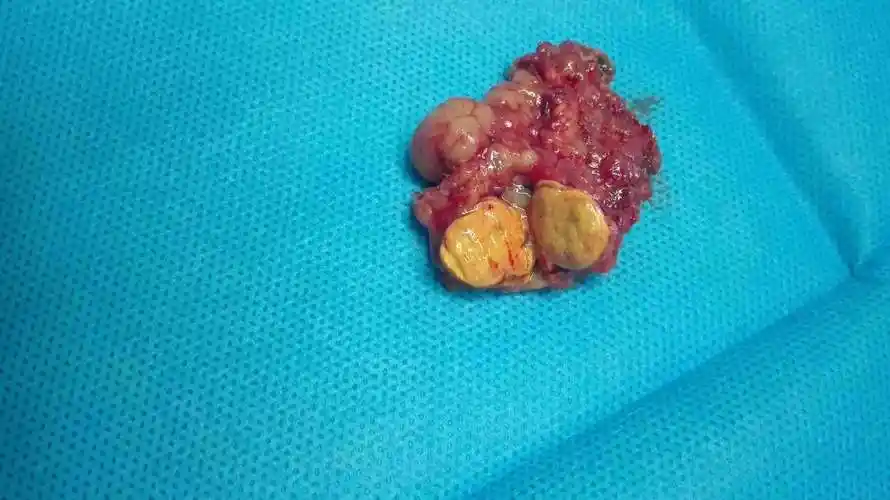 半个小时,成功切除肾上腺原发性醛固酮腺瘤 - 好大夫在线