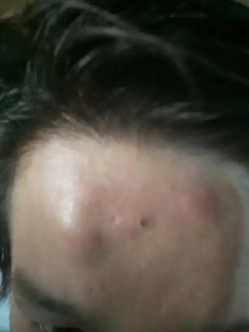 额头突然肿了,是在白天,按着也不痛?