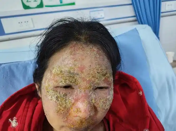 求助头面颈部大面积黄色结痂病例