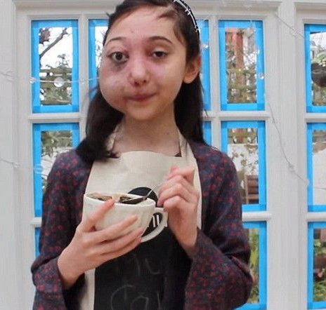 11岁的尼基·克里斯托患有avm (动静脉畸形症),面部严重变形.