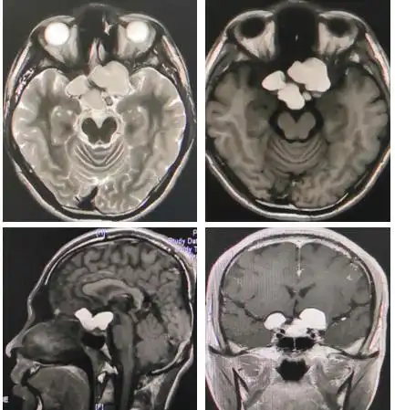 颅内长了"脂肪瘤"莫惊慌_脂肪瘤_症状表现_治疗方式_相关疾病 - 好