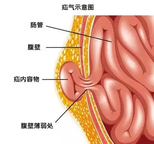 发现疝气之后怎么办?有些人发现疝块之后觉得不痛不痒,也就没在意.