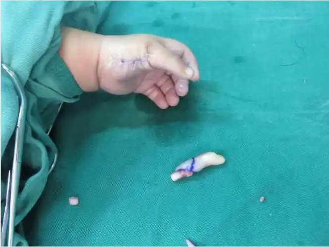 小孩多指切除案例_多指畸形_手术_治疗方法_治疗方式 - 好大夫在线