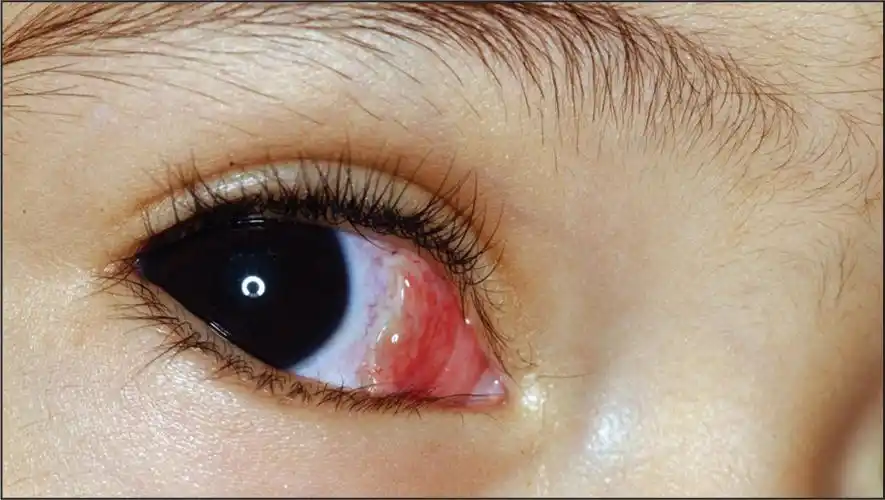 cut and paste: sutureless conjunctival closure in