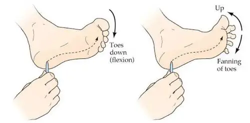 结果的判定标准 babinski 征的正常反应是屈髋屈膝屈踝,所有足趾跖屈