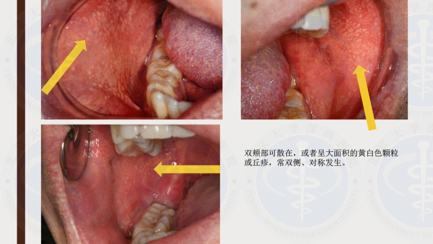 目前迷脂症没有相应的药物哦,如果觉得影响美观